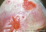 Temporalinis arteritas