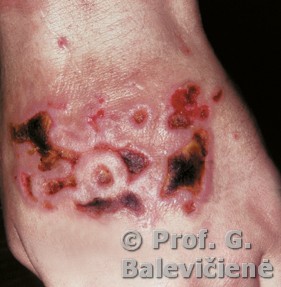 Gangreninė pioderma