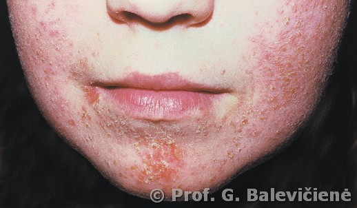 Stafilokokinė impetiga