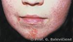 Stafilokokinė impetiga