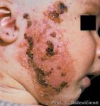 Stafilokokinė impetiga
