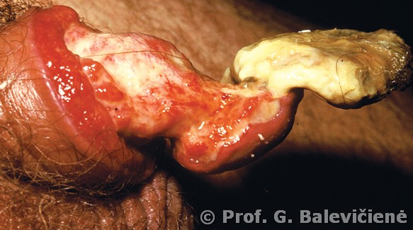 Varpos gangrena