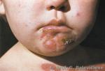 Stafilogeninė impetiga     