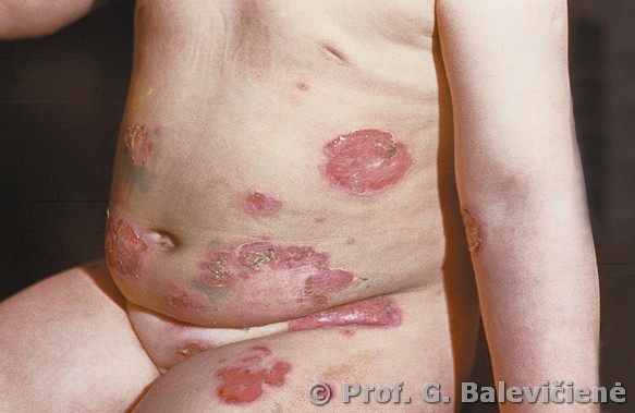 Pūslinė impetiga