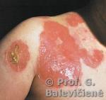 Pūslinė impetiga