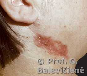 Skrufuloderma