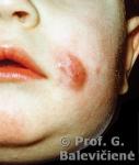 Metastazinis tuberkuliozini abscesas