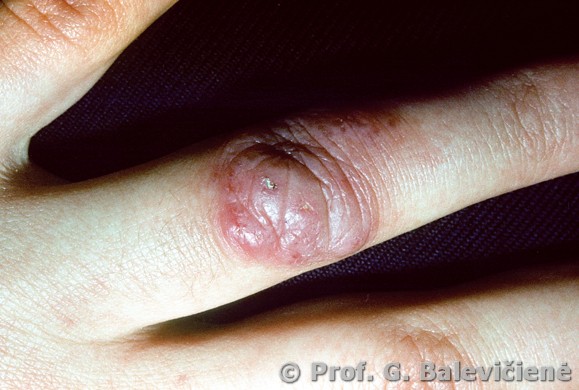  Mycobacterium marinum  infekcija