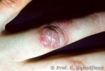  Mycobacterium marinum  infekcija