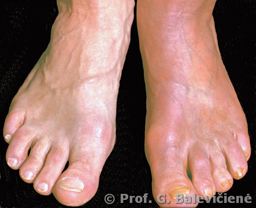 Lėtinis atrofuojantis galūnių dermatitas 