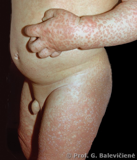 Vaikų galūnių papulinių berimų dermatitas