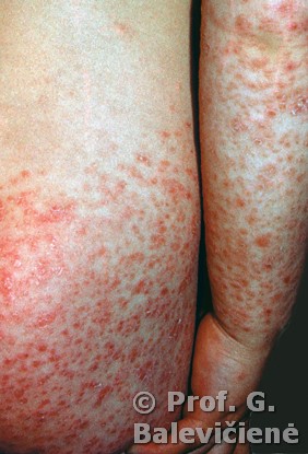 Vaikų galūnių papulinių berimų dermatitas