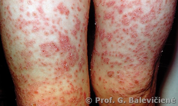 Vaikų galūnių papulinių berimų dermatitas