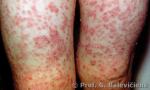 Vaikų galūnių papulinių berimų dermatitas