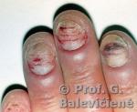 Apynagės ir nago kandidamikozė