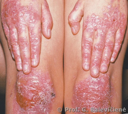 Epidermolysis bullosa dysthrophica dominans  
