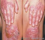 Epidermolysis bullosa dysthrophica dominans  