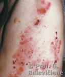 Atvirkštinė recesyvinė distrofinė  pūslinė epidermolizė