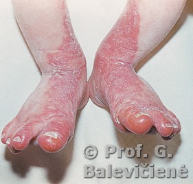 Enteropatinis akrodermatitas