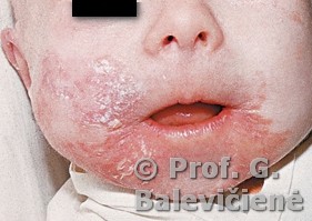 Enteropatinis akrodermatitas