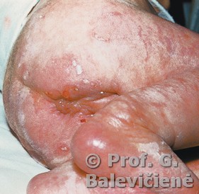 Enteropatinis akrodermatitas