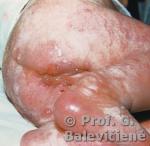Enteropatinis akrodermatitas