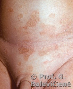 Epidermolizinė ichtiozė