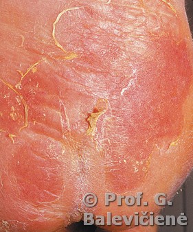 Epidermolizinė ichtiozė