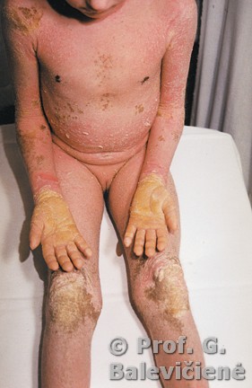 Epidermolizinė ichtiozė ( eritrodermija,delnų ir kelių keratozė)