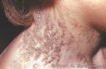 Dygliuotojo sluoksnio epidermolizinis apgamas 