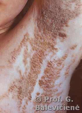 Dygliuotojo sluoksnio epidermolizinis apgamas 