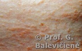 Elastinė pseudoksantoma
