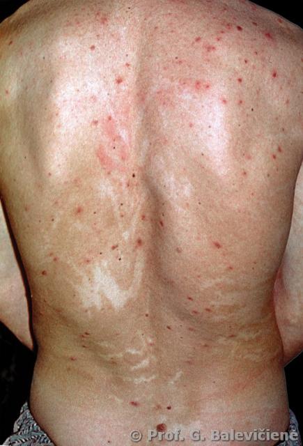 Cowden’s sindromas