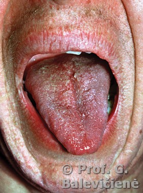 Cowden’s sindromas