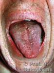 Cowden’s sindromas