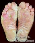 Cowden’s sindromas
