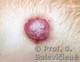 Hemangioma