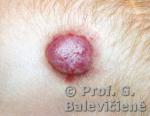 Hemangioma