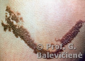 Epiderminis apgamas