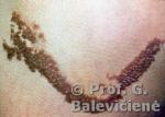 Epiderminis apgamas