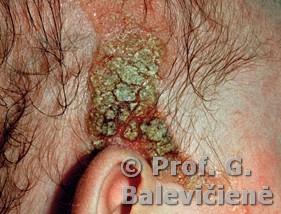 Riebalinis apgamas