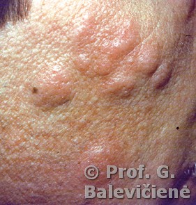 Cysta epidermoides 