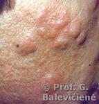 Cysta epidermoides 