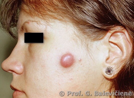 Trauminė epidermoidinė cista