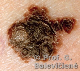 Paviršinė melanoma
