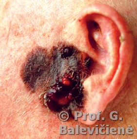 Mazginė melanoma 