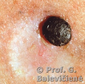 Mazginė melanoma 