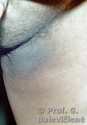 Acanthosis nigricans