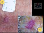 Plokščialąstelinis odos vėžys aktininės keratozės fone (m. Boweni)