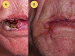 Lūpos plokščialąstelinis vėžys